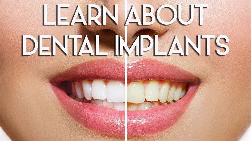Have a Perfect Smile With Dental Implants ArticleCube