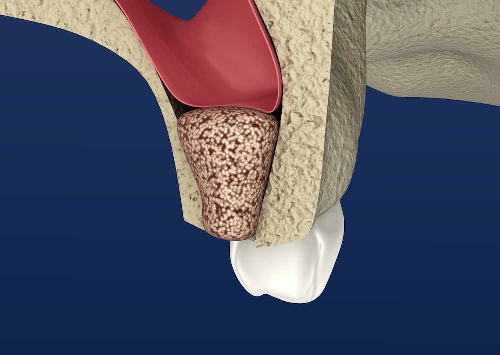 Sinuscam What to Know About Sinus Lift | ArticleCube