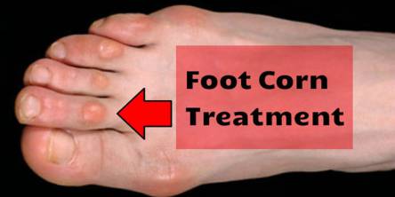 How to Treat Foot Corn With Herbal Remedies