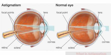 What is Astigmatism