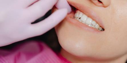 Why Retainers Are Your Ultimate Smile Safeguard