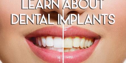 Smile Makeover, Dental Implants