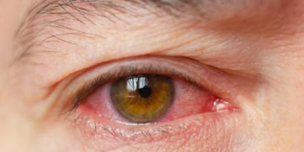 5 Pink Eye Symptoms You Should Be Aware Of