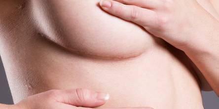 5 Ways to Reduce the Visibility of Breast Lift Scars