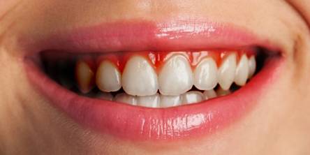 6 Effective Tips on How to Prevent Gum Disease