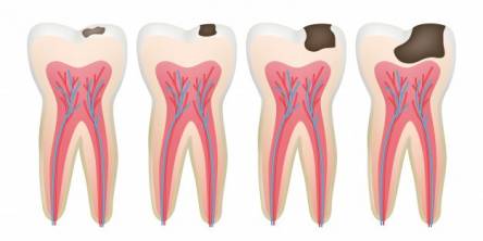 6 Facts About Tooth Decay That You Should Know About 