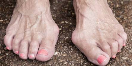 7 Everyday Habits That Secretly Make Hammer Toes More Painful