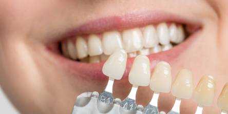 7 Questions to Ask Your Dentist Before Getting Veneers