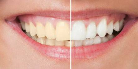 Efficient Types and Methods of Teeth Whitening