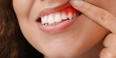 Prevention and Treatment of Gingivitis