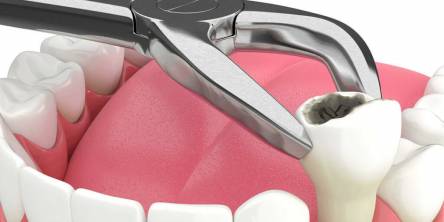 The Tooth Dilemma: When It's Time to Say Goodbye to Your Pearly Whites