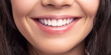 Top 6 Important Dental Veneers Facts You Need to Know