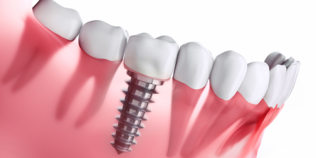 What You Need to Know About Endosteal Implant?
