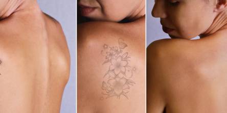 Why Laser Tattoo Removal Is Smarter Than Other Methods