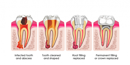 Root Canal Treatment Langley BC