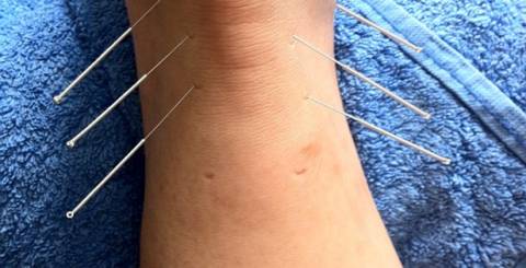 A Pain Center May Offer Acupuncture For Chronic Pain Sufferers A Pain Center May Offer Acupuncture For Chronic Pain Sufferers