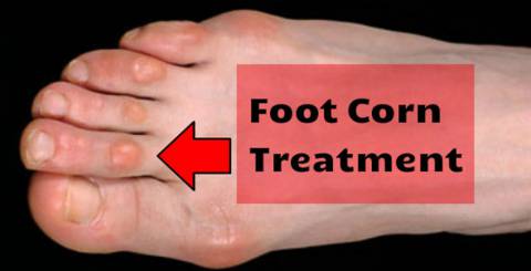 How to Treat Foot Corn With Herbal Remedies