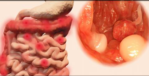 ulcerative colitis