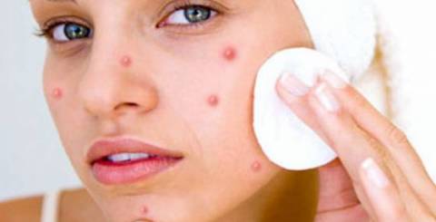 Get Rid of Pimple Mark Naturally