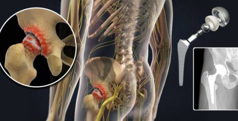 Hip Replacement Surgery Hip Replacement Surgery
