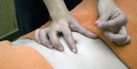 Acupuncture Acupuncture