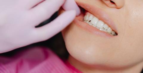 Why Retainers Are Your Ultimate Smile Safeguard