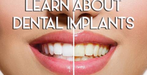 Have a Perfect Smile With Dental Implants Smile Makeover, Dental Implants