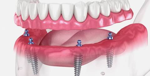 5 Factors to Consider Before Getting All-on-4 Dental Implants for Your Smile
