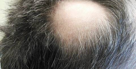 5 Different Hair Loss Treatments