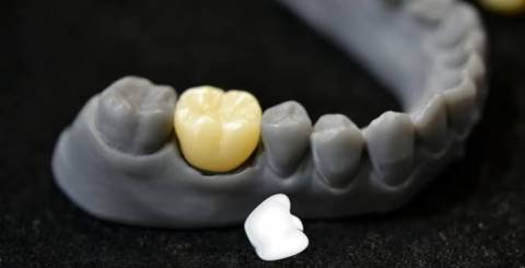 6 Common Reasons Your Dental Crown Feels Loose
