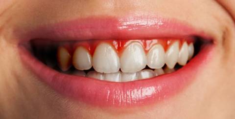 6 Effective Tips on How to Prevent Gum Disease