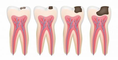 6 Facts About Tooth Decay That You Should Know About 