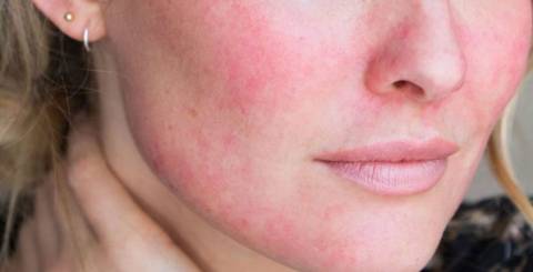 7 Common Reasons for Red Face That May Surprise You 