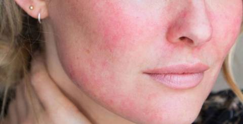 7 Common Reasons for Red Face That May Surprise You 7 Common Reasons for Red Face That May Surprise You