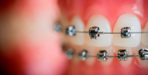 9 Facts About Damon Braces That You Should Be Aware Of 9 Facts About Damon Braces That You Should Be Aware Of