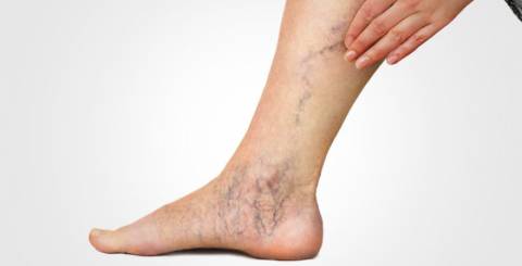 9 Reasons to Visit a Vein Doctor Before Your Legs Stage a Rebellion 9 Reasons to Visit a Vein Doctor Before Your Legs Stage a Rebellion