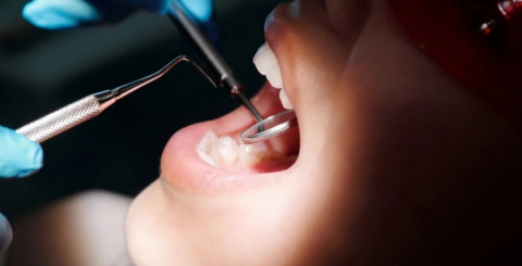 Can Adults Benefit From Dental Sealants