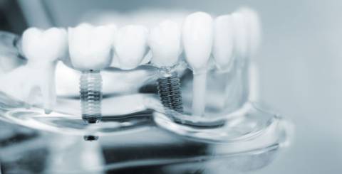 Choosing Between Immediate or Delayed Dental Implants