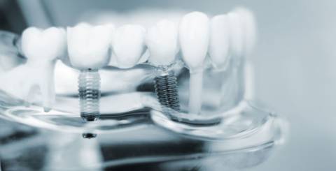 Choosing Between Immediate or Delayed Dental Implants Choosing Between Immediate or Delayed Dental Implants
