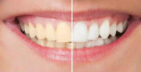 Efficient Types and Methods of Teeth Whitening