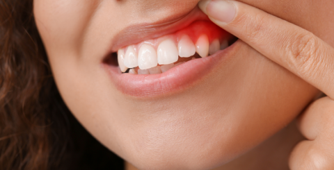 Prevention and Treatment of Gingivitis