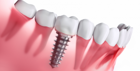 What You Need to Know About Endosteal Implant?