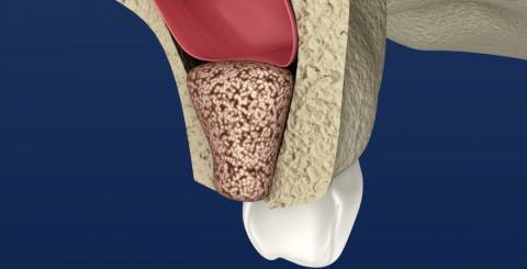 What to Know About Sinus Lift