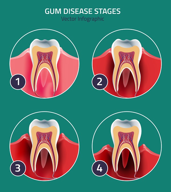 Gum Disease Stages